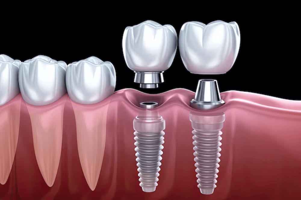 Dental implant